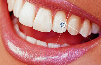 32 Smile Stone dental jewellery